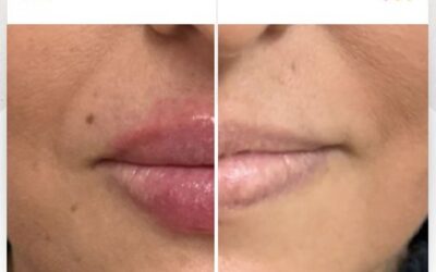 Mira el cambio de nuestra paciente, Relleno de labios en solo $399 USD