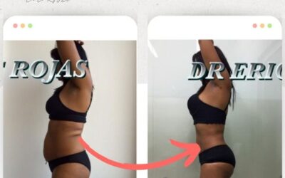 Cambios realmente increíbles logrados con Slim Láser.