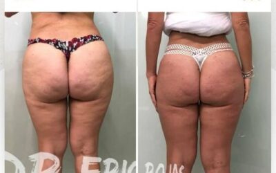 Contamos con la mejor herramienta para eliminar la celulitis.