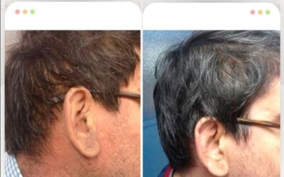 Cuida tu piel de la Psoriasis. 🆒👇