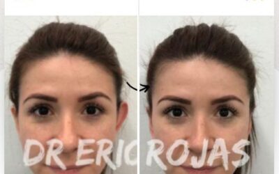 Dermo Otoplastía, corrección de orejas.