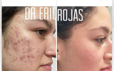 Limpia tu rostro, elimina el acné y recupera tu seguridad.