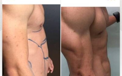 Marcaje con Slim Láser.