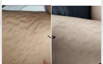 Elimina las estrías de tu cuerpo.