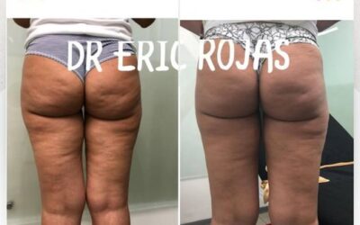Disminuye la celulitis con nuestro láser