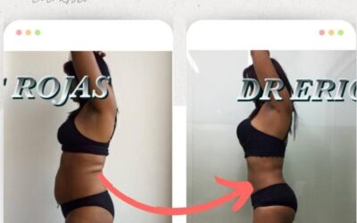 Cambios realmente increíbles logrados con Slim Láser