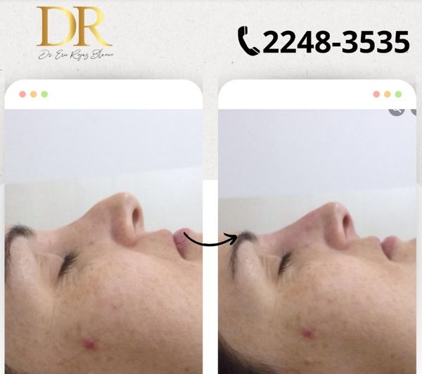 Rinolift Correcci n De Nariz Con La Mejor T cnica Dr Eric Rojas 