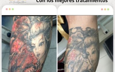 ¿Tienes problemas de piel por tus tatuajes?, te podemos ayudar.