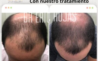 Recupera tu cabello con la mejor oferta.