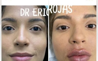 Relleno y moldeado de labios.