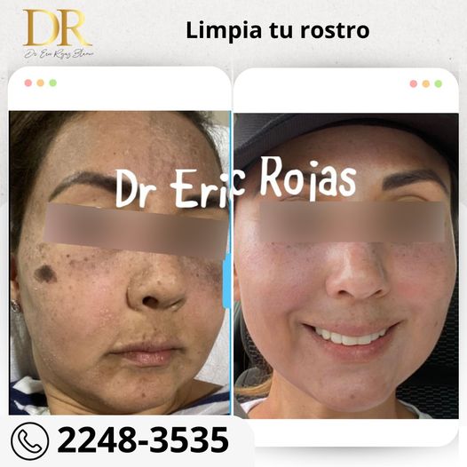 Elimina las manchas de tu rostro.