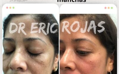 Limpia tu rostro de las manchas.