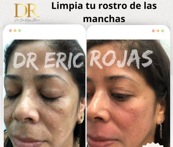 Limpia tu rostro de las manchas.