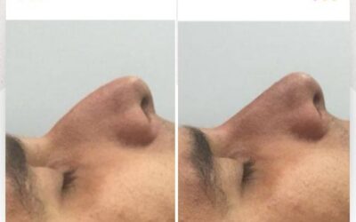 Rinolift es la mejor técnica para mejorar tu perfil.