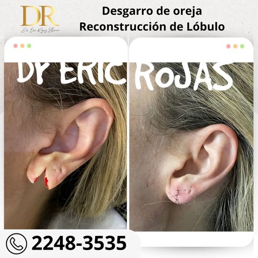 Desgarro de Oreja y reconstrucción del lóbulo.