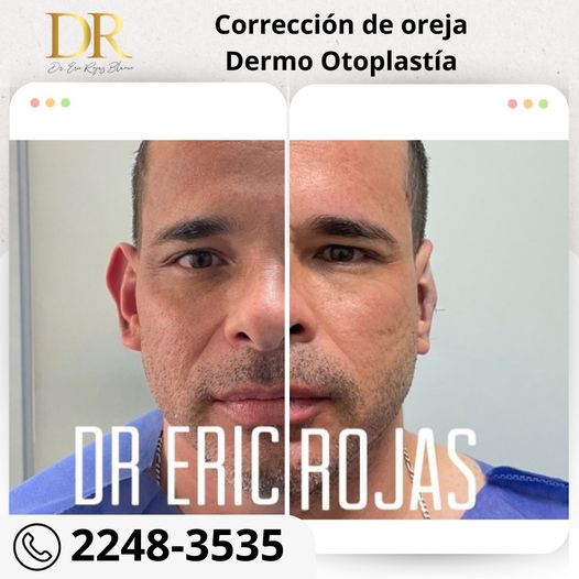 Corrección de orejas con la dermo otoplastía.