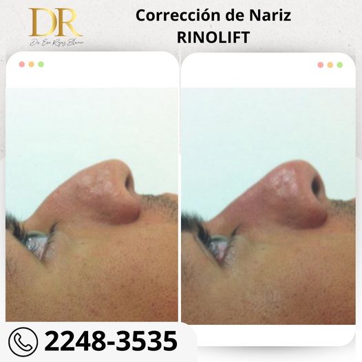 Rinolift es la mejor técnica para mejorar tu perfil