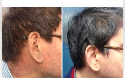Cuida tu piel de la Psoriasis.