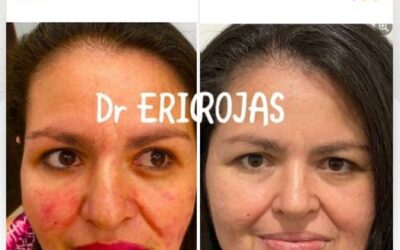 La rosacea si se cura.