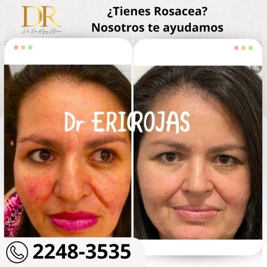 La rosacea si se cura.