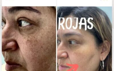 Elimina las manchas de tu rostro con la mejor técnica.
