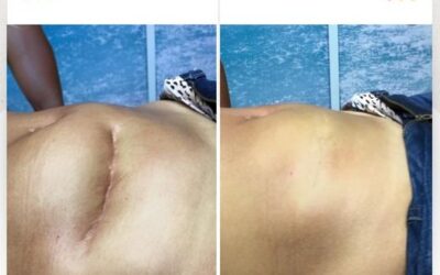 Solución de cicatriz en abdomen.