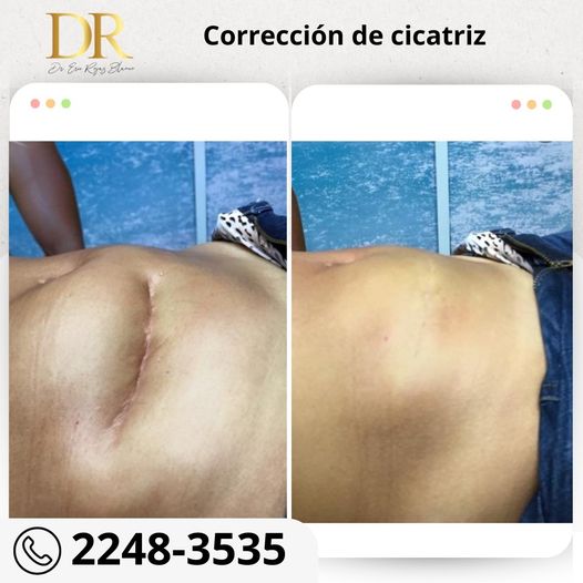 Solución de cicatriz en abdomen.