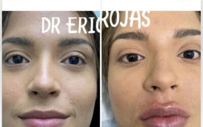 ¡Solo este mes, increíble oferta de Botox!