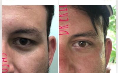 Rejuvenecimiento de rostro, no dudes en visitarnos.