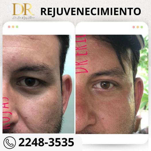 Rejuvenecimiento de rostro, no dudes en visitarnos.