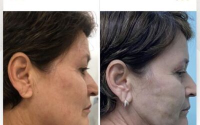 Slim Laser