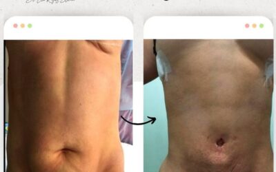 Mira los increíbles resultados del Slim Laser, ¿Qué te pareció el resultado? 👇