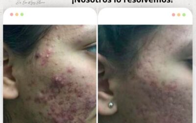 Elimina el acné con nuestro increíble tratamiento