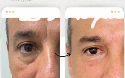 Rejuvenece tu rostro con las mejores técnicas.