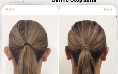 Dermo otoplastía, el mejor mémtodo para corregir tus orejas.