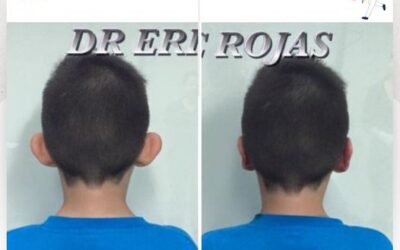 Dermo-Otoplastía para los pequeños del hogar.