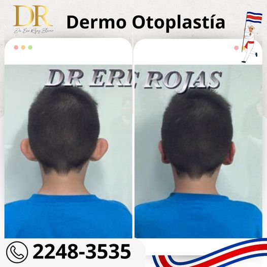 Dermo-Otoplastía para los pequeños del hogar.