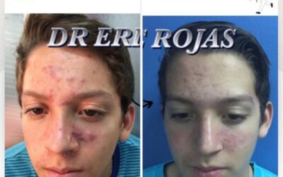 Tratamiento Garantizado para eliminar el acné de tu vida.