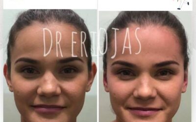 Corrección de orejas con dermo otoplastía.