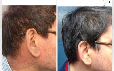 Cuida tu piel de la Psoriasis.