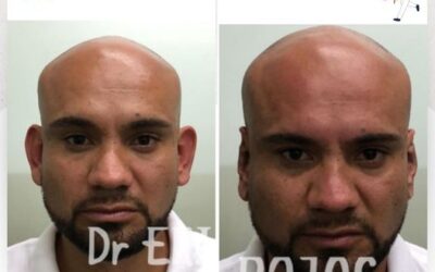 Corrección de orejas con la Dermo Otoplastía.