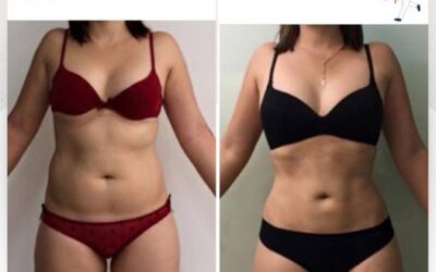Cambios increíbles con Slim Láser