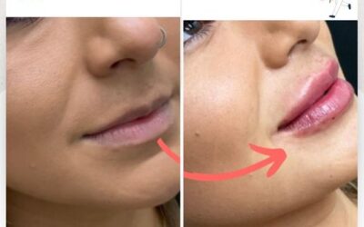 Relleno de labios es la manera para lucir tus increíbles labios.