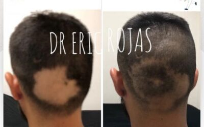 La Caída de cabello tiene solución con nosotros.