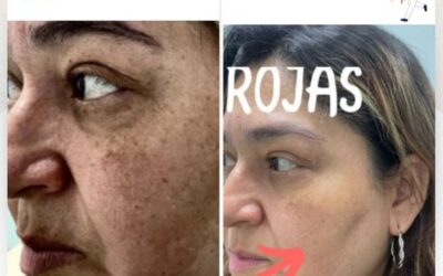 Elimina las manchas de tu rostro con la mejor técnica.