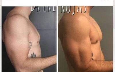 Slim láser en Brazos
