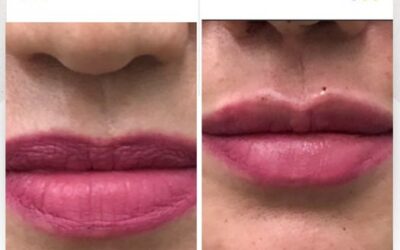 Relleno de labios con la mejor técnica.