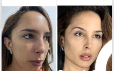 Contorno mandíbular, formación de pómulos y levantamiento de cejas.