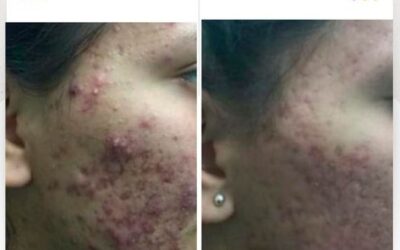 Elimina el acné con nuestro increíble tratamiento