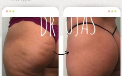 Elimina la celulitis de tu vida con los mejores procedimientos